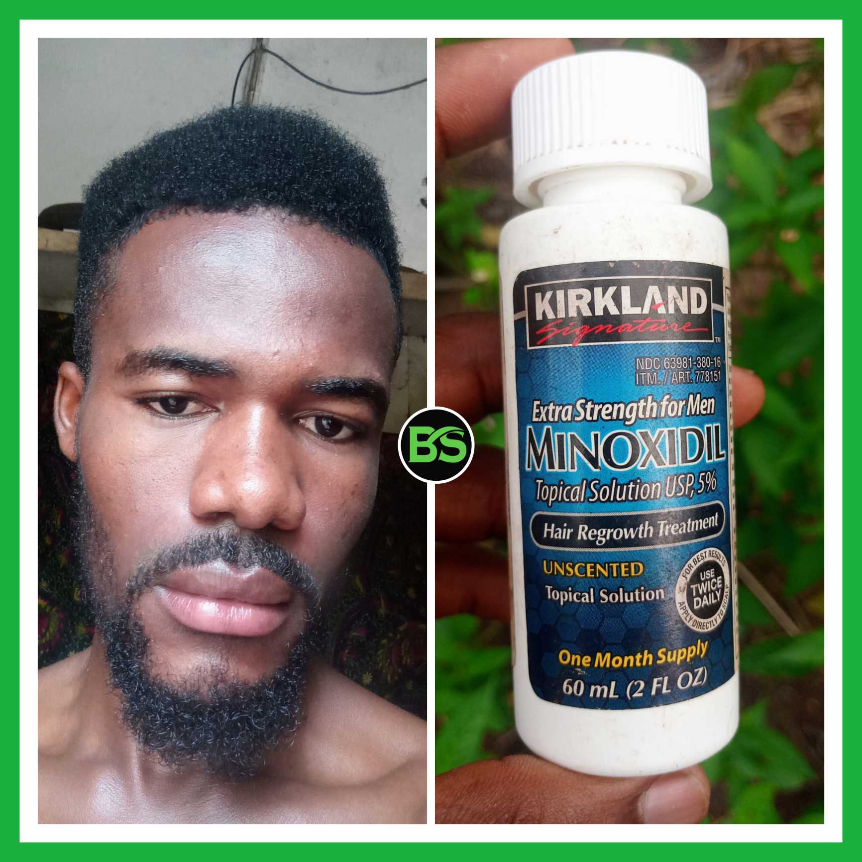 tæt spredning kok Minoxidil For Beard & Hair Growth - I Used Minoxidil To Grow My Beard From  Nothing (And Hair Corners Too) - BeautySparkReview