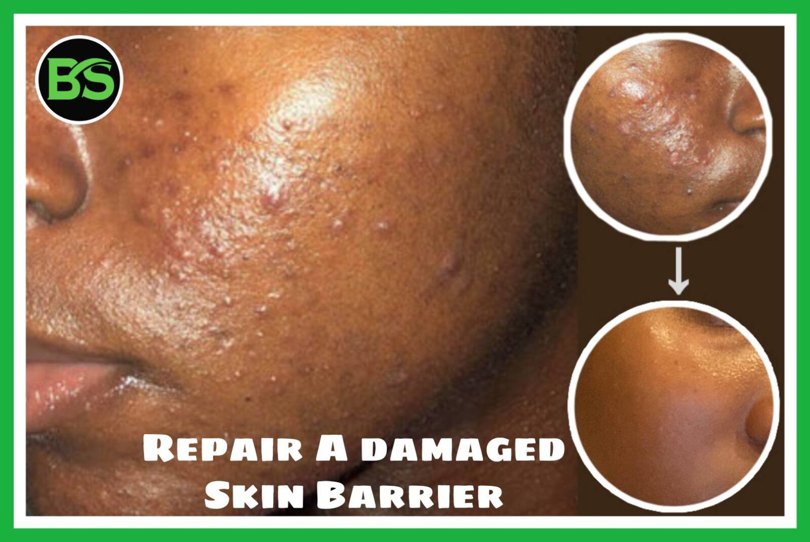 how-to-repair-a-damaged-skin-barrier-the-comprehensive-guide